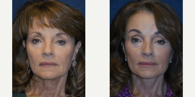 Facelift procedure image