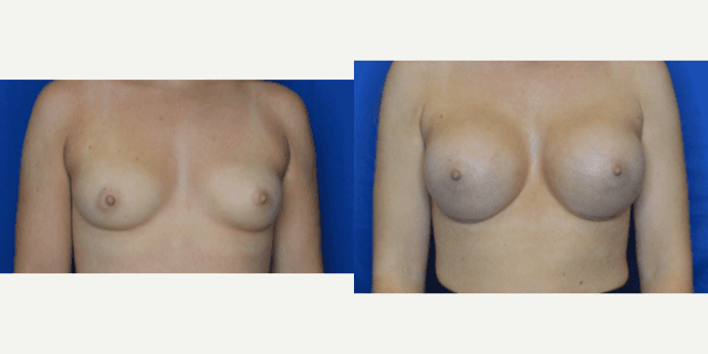 Mommy Makeover procedure image