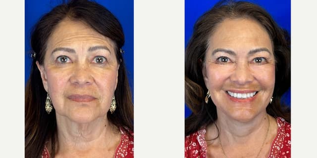 Eyelid Surgery (Blepharoplasty) procedure image