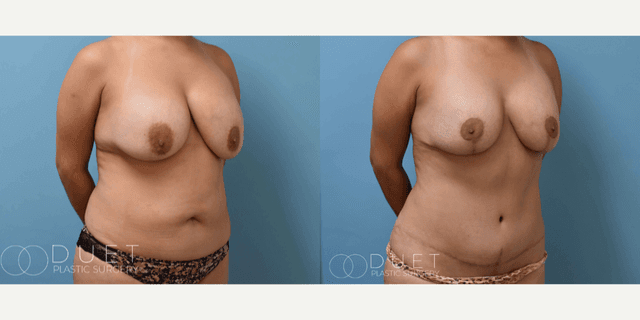 Breast Augmentation procedure image