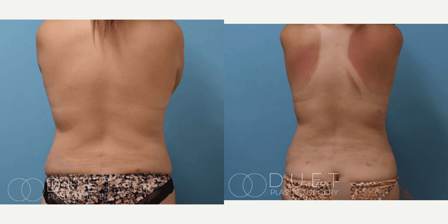 Skin Tightening procedure image