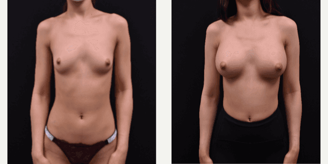 Breast Augmentation procedure image
