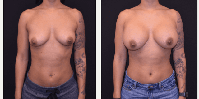 Mommy Makeover procedure image