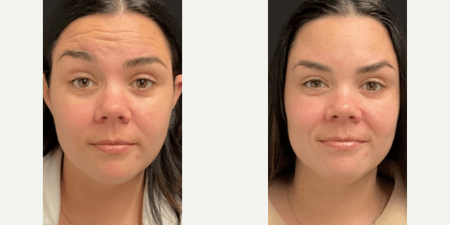 Fillers & Injectables (e.g. Botox, Juvederm) procedure image