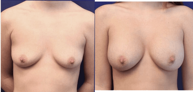 Breast Augmentation procedure image