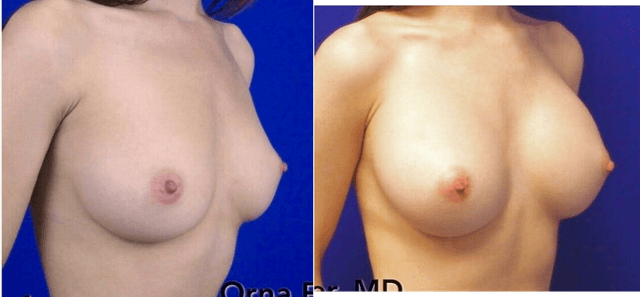 Mommy Makeover procedure image