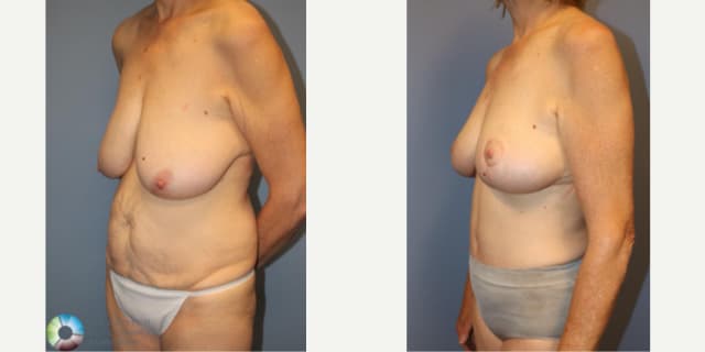 Liposuction procedure image