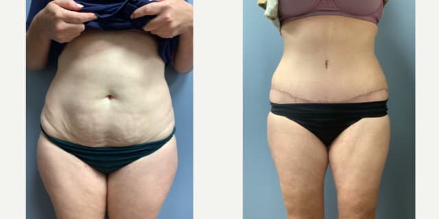 Mommy Makeover procedure image