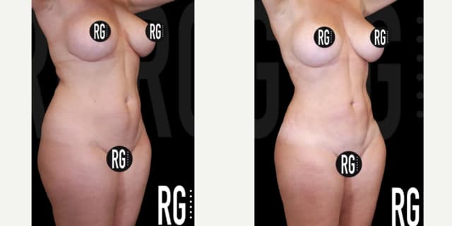Lipo 360 procedure image