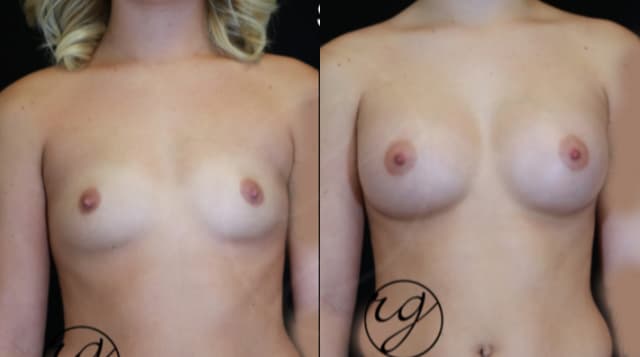 Mommy Makeover procedure image