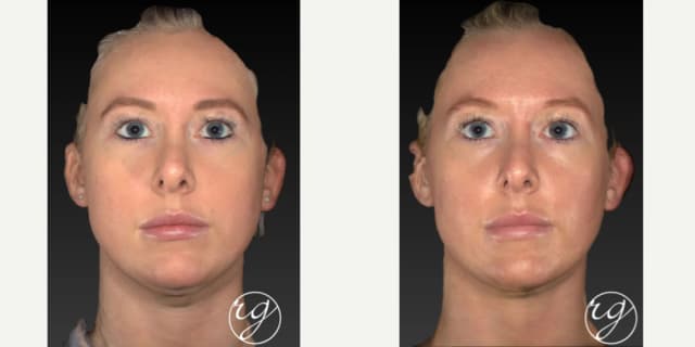 Cheek Enhancement procedure image