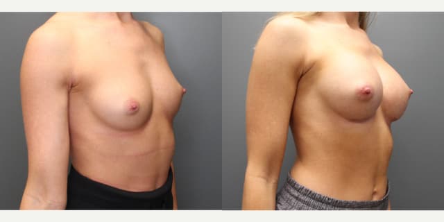 Breast Augmentation procedure image