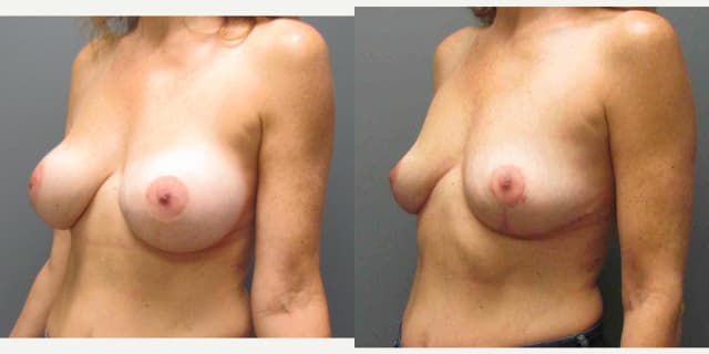 Mommy Makeover procedure image