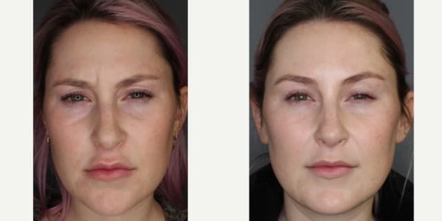 Facelift procedure image