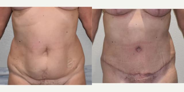 Skin Tightening procedure image