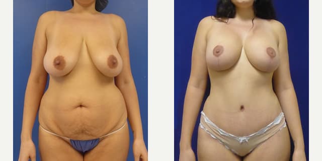 Breast Augmentation procedure image