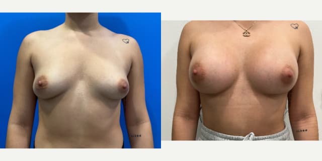 Mommy Makeover procedure image