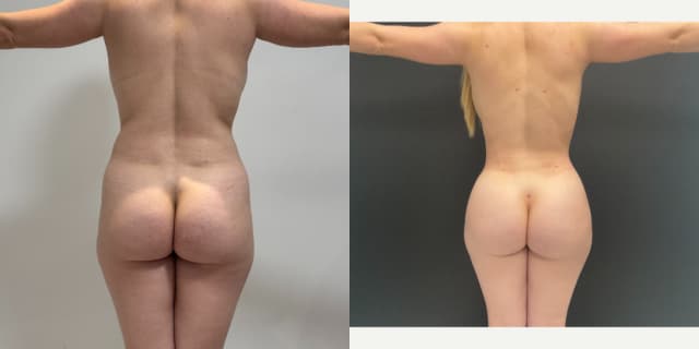 Brazilian Butt Lift (BBL) procedure image