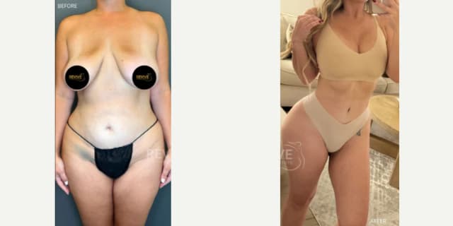 Skin Tightening procedure image