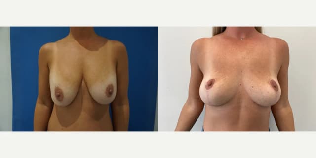 Mommy Makeover procedure image