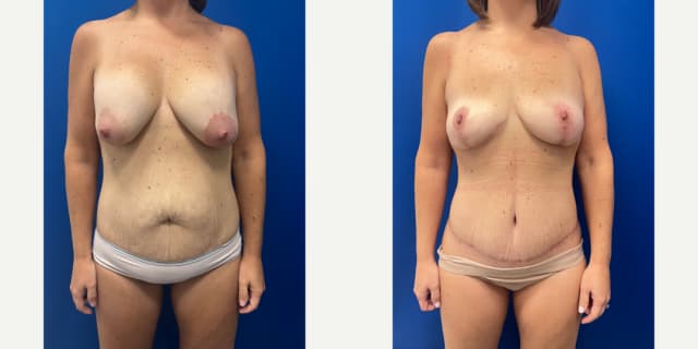 Breast Augmentation procedure image