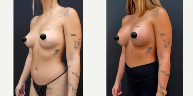 Breast Augmentation procedure image