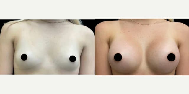 Breast Augmentation procedure image