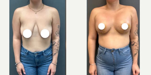 Mommy Makeover procedure image