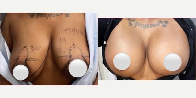 Skin Tightening procedure image