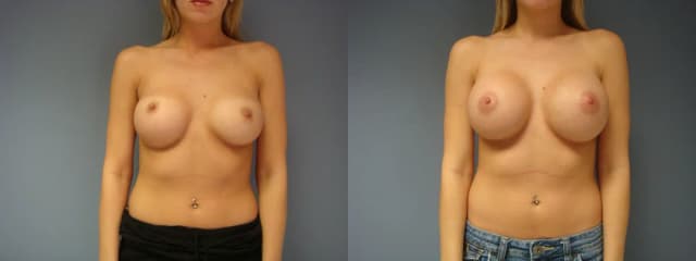 Breast Augmentation procedure image