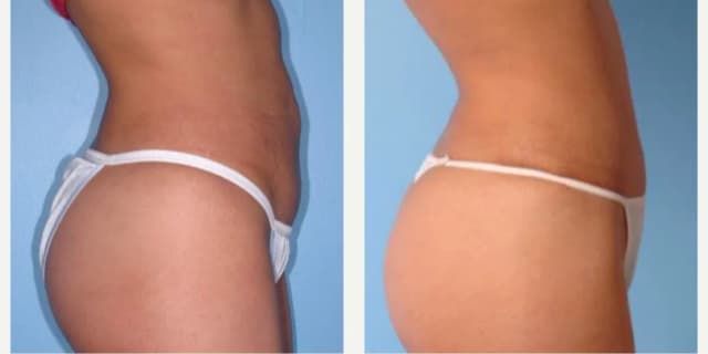 Body Lift procedure image