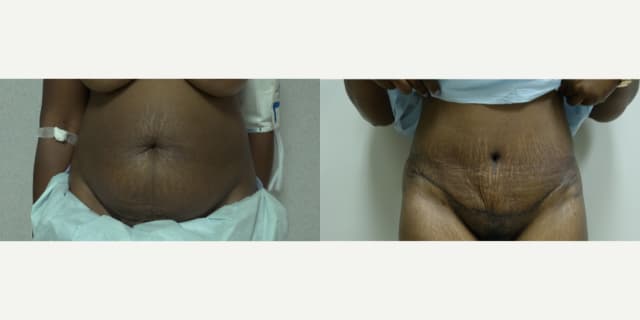 Tummy Tuck (Abdominoplasty) procedure image