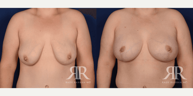 Mommy Makeover procedure image