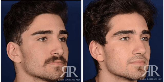 Rhinoplasty (Nose Job) procedure image