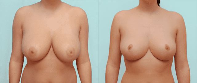 Mommy Makeover procedure image