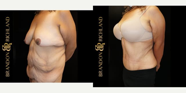 Mommy Makeover procedure image