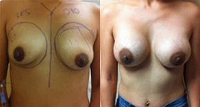 Mommy Makeover procedure image