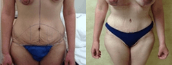 Tummy Tuck (Abdominoplasty) procedure image