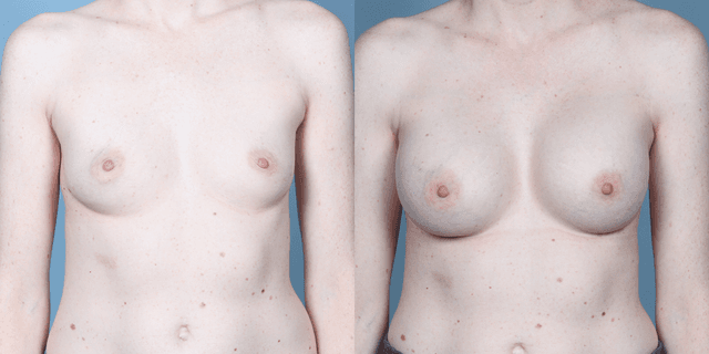 Mommy Makeover procedure image