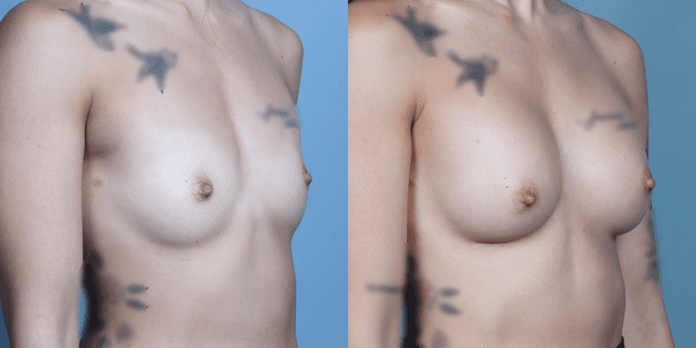 Breast Augmentation procedure image