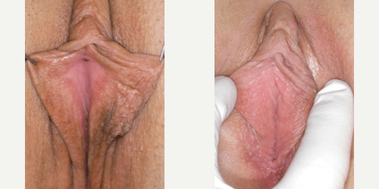 Labiaplasty procedure image