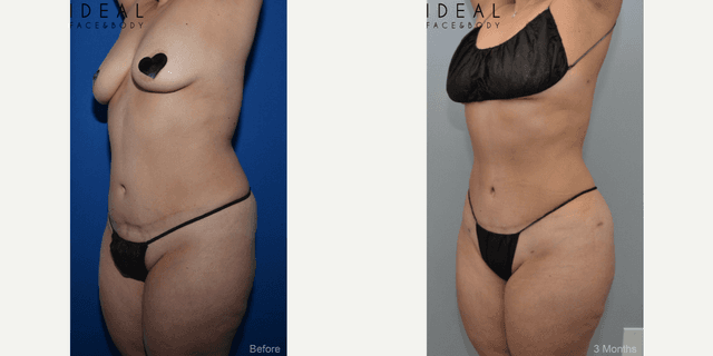 Lipo 360 procedure image