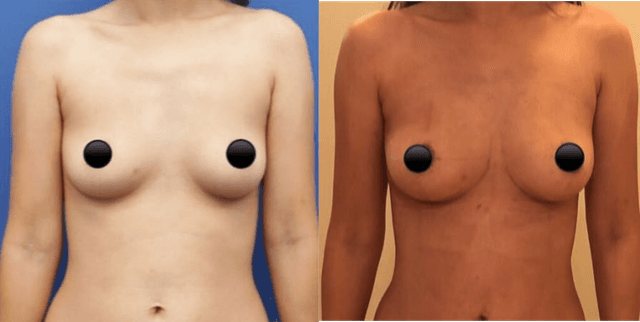Breast Augmentation procedure image