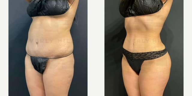 Body Lift procedure image