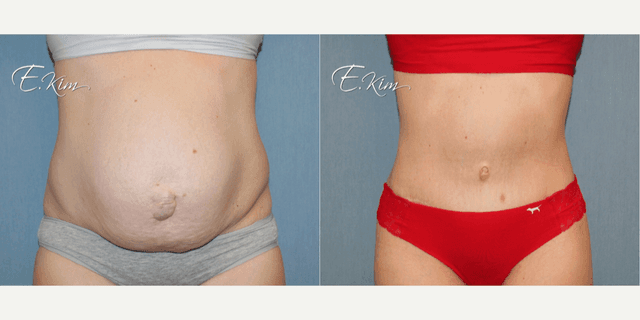 Skin Tightening procedure image