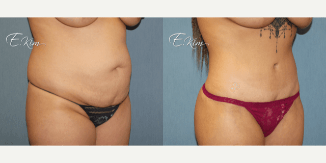 Mommy Makeover procedure image