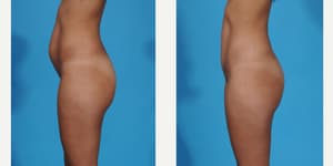 Skin Tightening procedure image