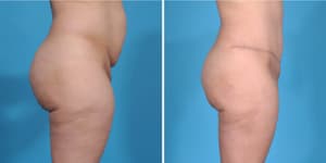 Mommy Makeover procedure image