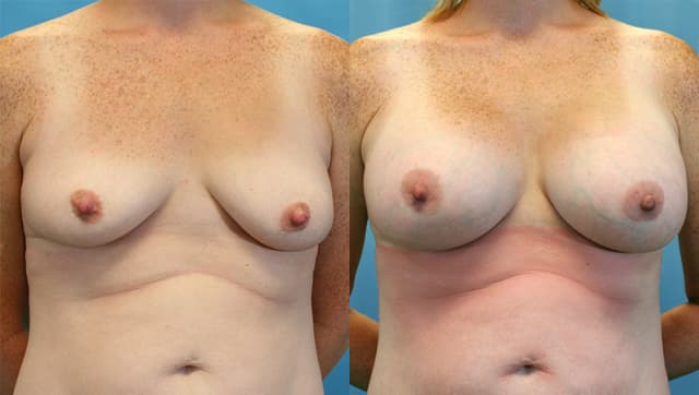 Breast Augmentation procedure image