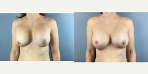 Mommy Makeover procedure image